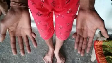This MP family members have 12 fingers in hand and feet