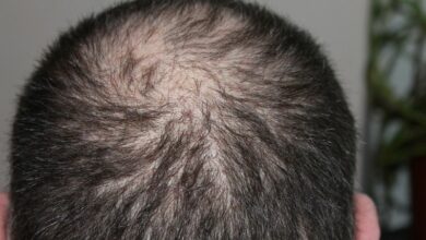 Air pollution may result in hair loss