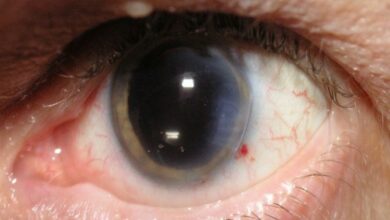 Here's another reason for you to get cataract surgery
