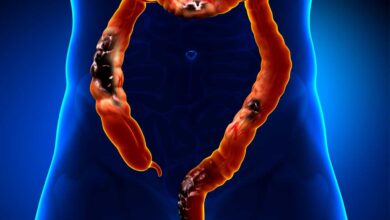 Colorectal cancer on an upswing in South India