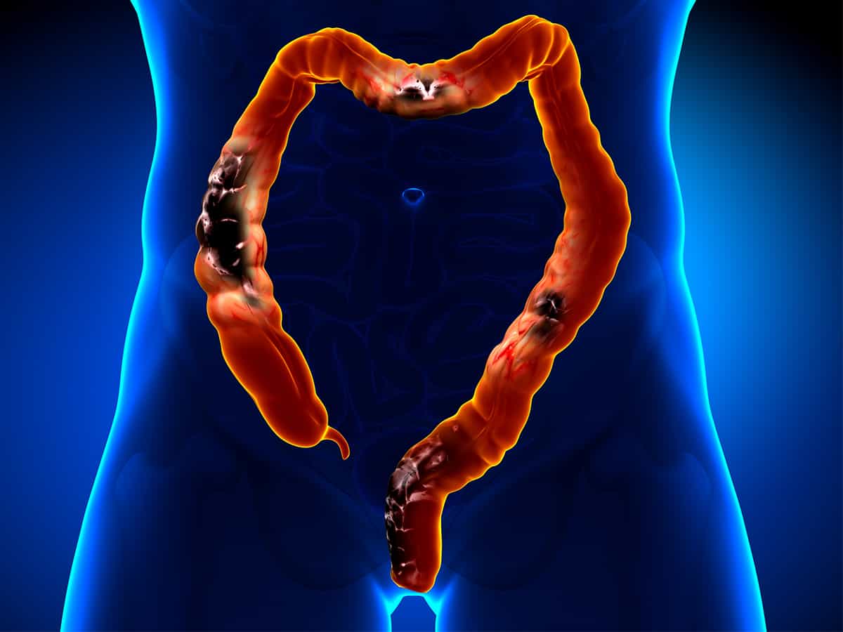 Colorectal cancer on an upswing in South India