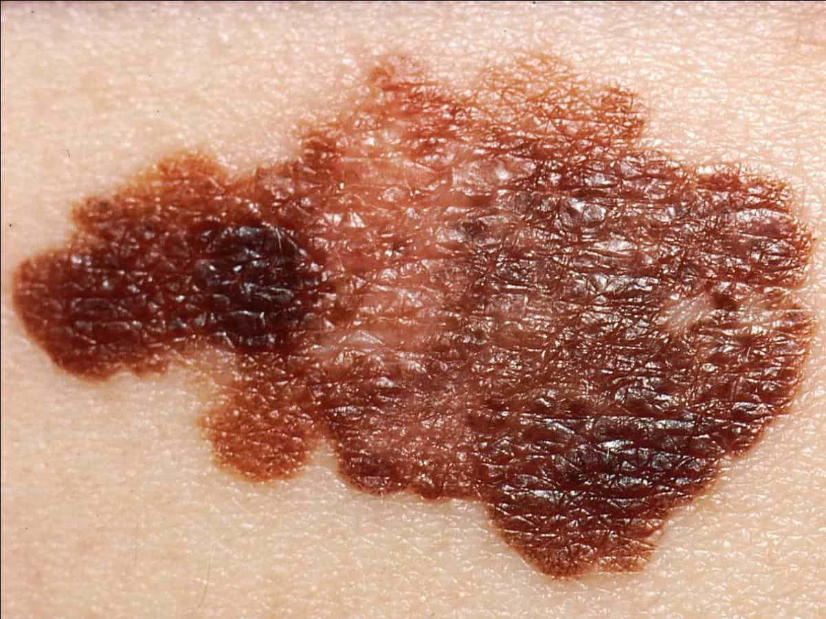 melanoma