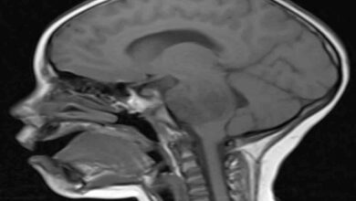 Doctors remove tumor from the brain of a 50-year-old