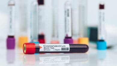 Laboratory sample of the novel Coronavirus