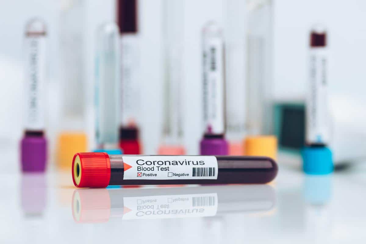 Laboratory sample of the novel Coronavirus