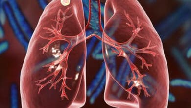 Cells damaged by chronic lung disease can result in severe Covid