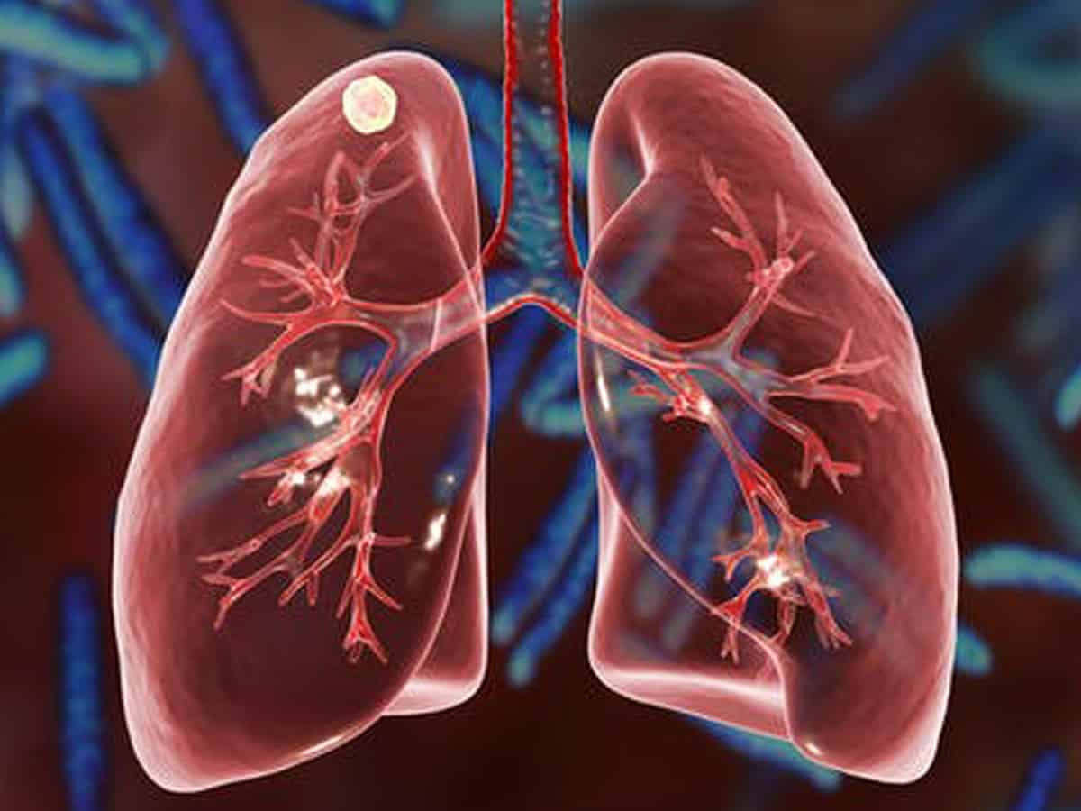 Cells damaged by chronic lung disease can result in severe Covid