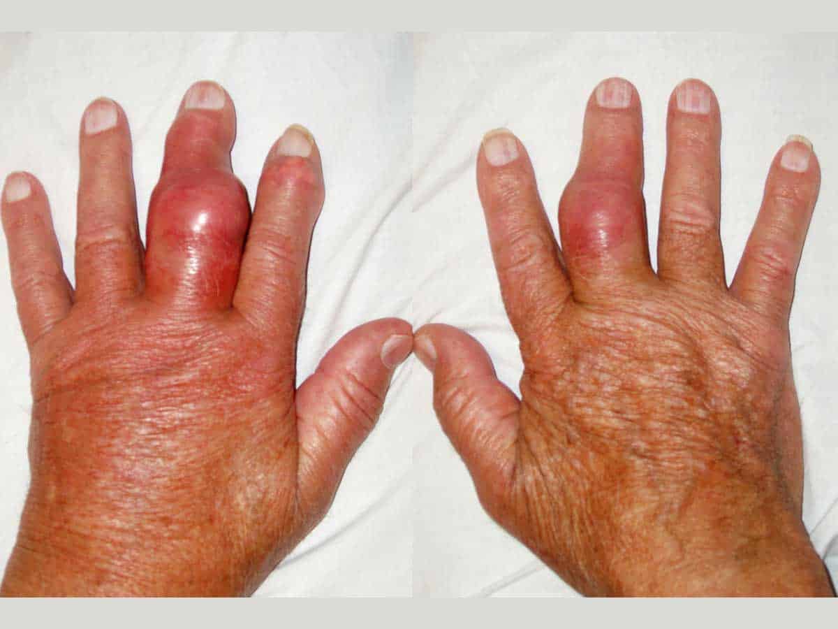 Gout