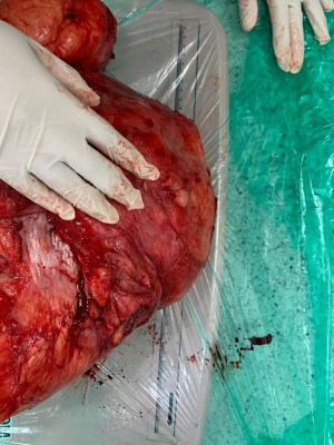 11-kg tumour extracted from Mumbai woman's abdomen