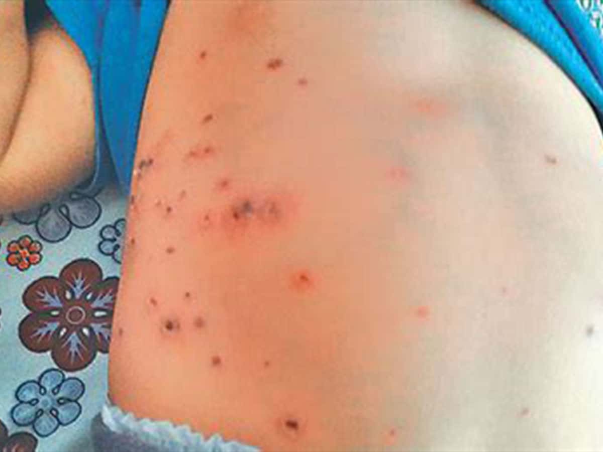Scrub Typhus disease in Noklak district of NaScrub Typhus disease in Noklak district of Nagaland galand