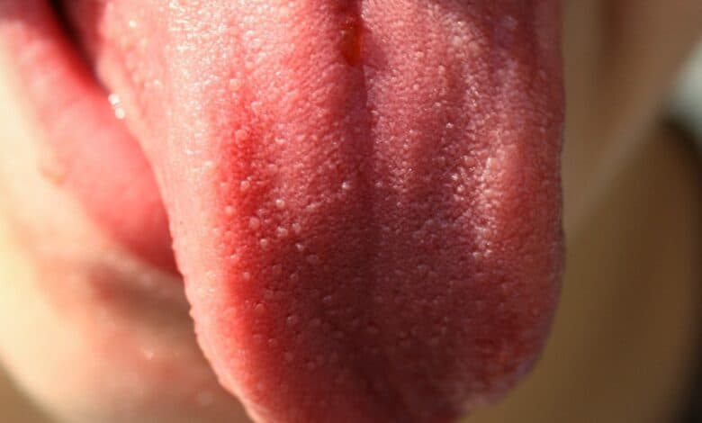 Strawberry tongue