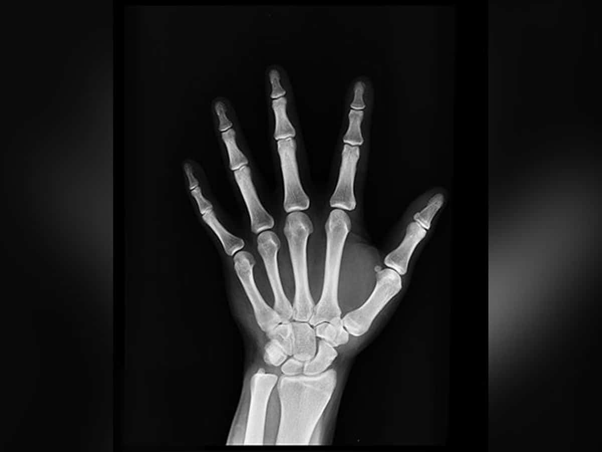 Signs that indicate your bones are weak
