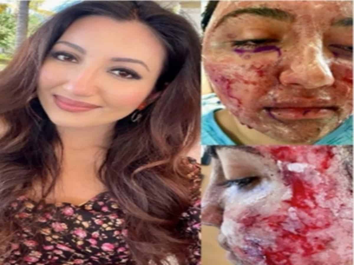 Indian-American Miss World 2021 first runner-up lives with pacemaker, Facial Burns