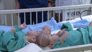Saudi Arabia: Doctors successfully separate Yemeni con-joined twins after 15-hour surgery