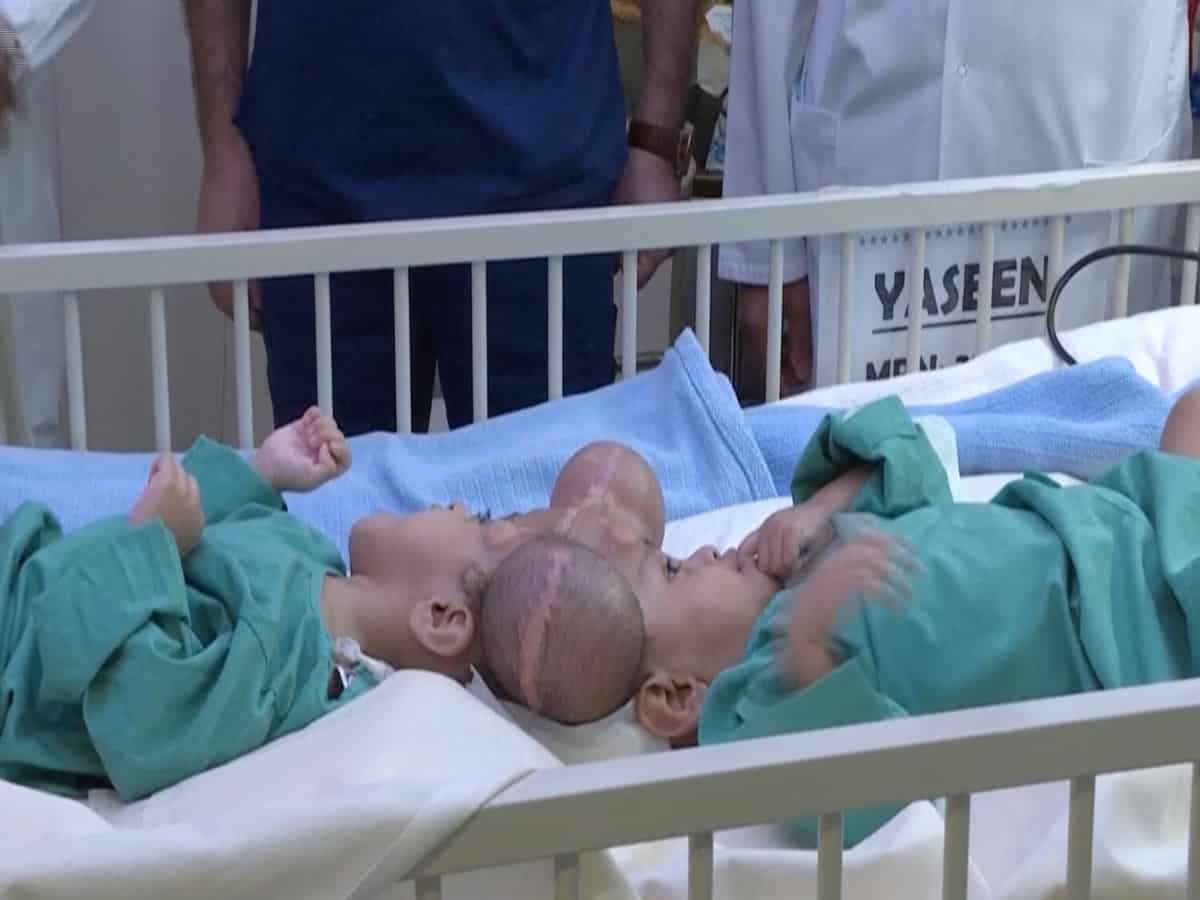 Saudi Arabia: Doctors successfully separate Yemeni con-joined twins after 15-hour surgery