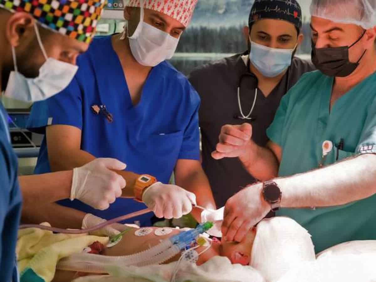 Saudi Arabia: Yemeni conjoined twin dies after 15-hour surgery