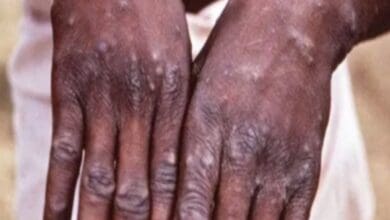 92 Monkeypox cases confirmed in 12 countries, may spread globally: WHO