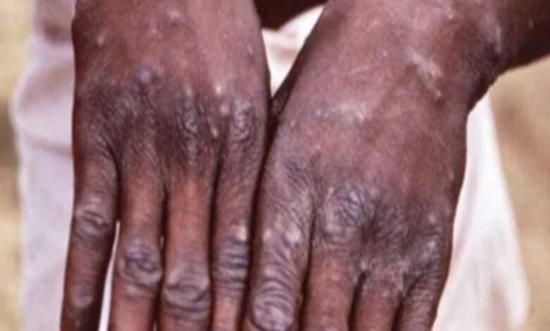 92 Monkeypox cases confirmed in 12 countries, may spread globally: WHO