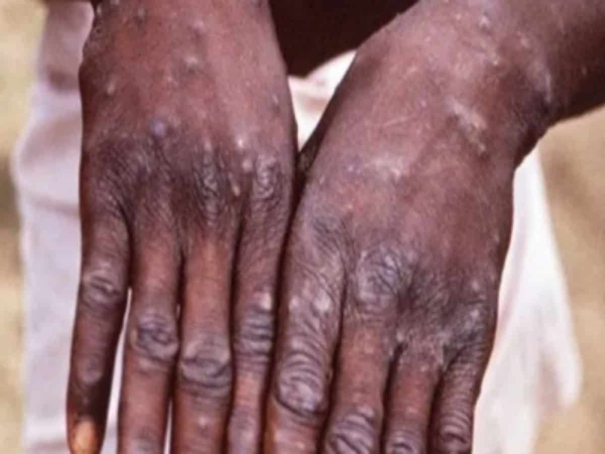 92 Monkeypox cases confirmed in 12 countries, may spread globally: WHO