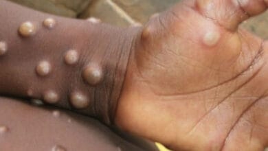 Monkeypox only spreads through air during face-to-face contact: CDC