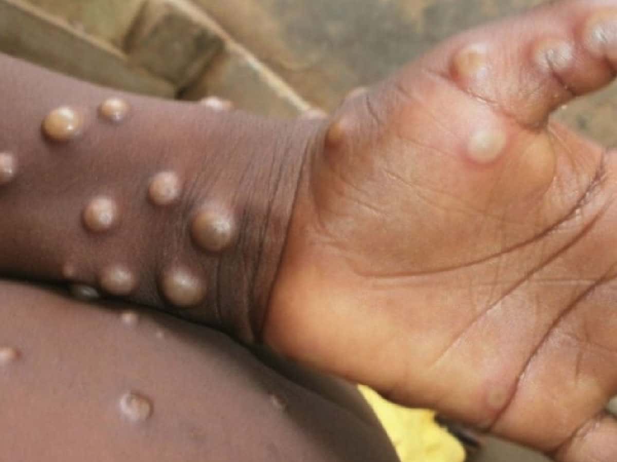 Monkeypox only spreads through air during face-to-face contact: CDC