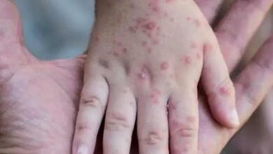 Monkeypox primarily spread via sexual contact, but containable: WHO
