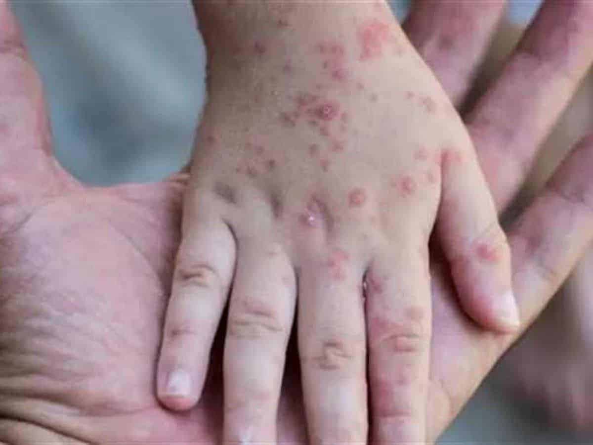 Monkeypox primarily spread via sexual contact, but containable: WHO