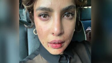 Photo of Priyanka Chopra's injured face with bruises & blood goes viral