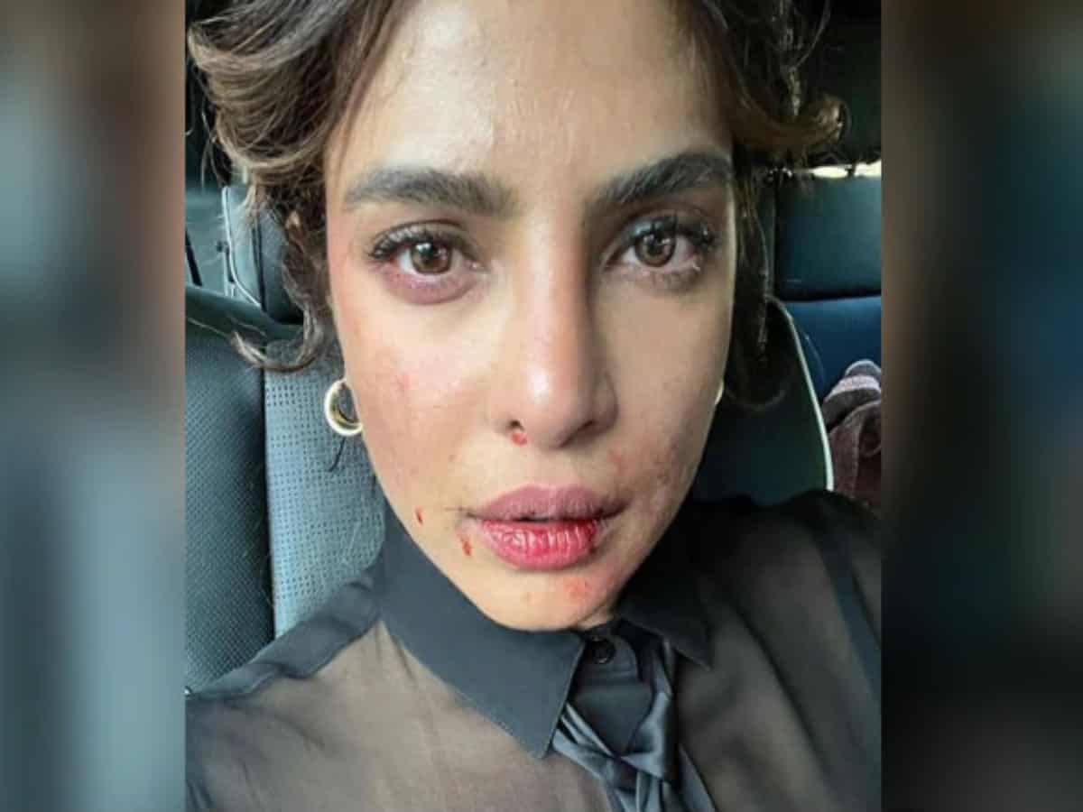 Photo of Priyanka Chopra's injured face with bruises & blood goes viral