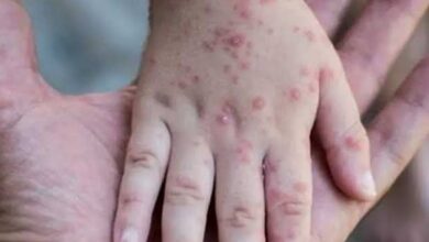 China tightens measures to prevent import of monkeypox virus