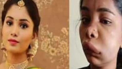 Swathi Sathish ends up with swollen face after botched root canal