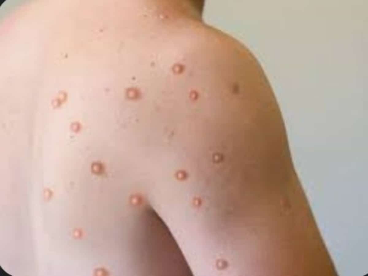 How chickenpox virus is linked to onset of Alzheimer's disease