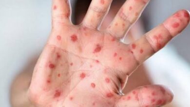Australians warned to be on high alert for monkeypox symptoms