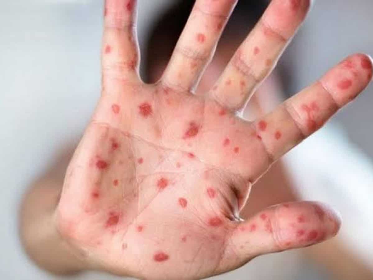 Australians warned to be on high alert for monkeypox symptoms