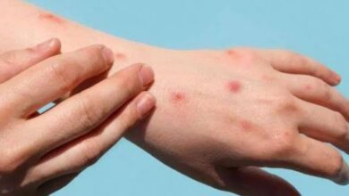 Monkeypox - The Siasat Daily