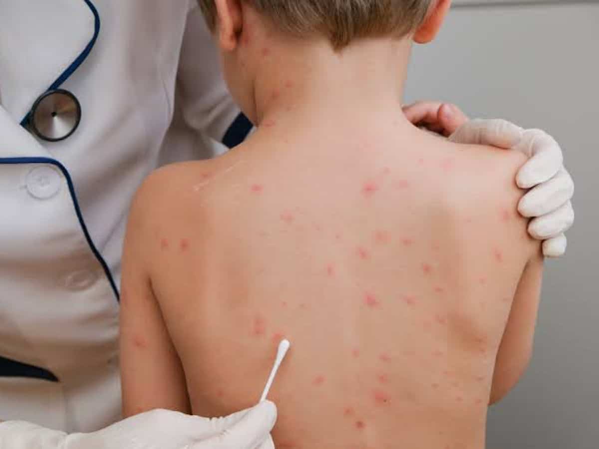 Bahrain announces opening of pre-registration for voluntary monkeypox vaccine