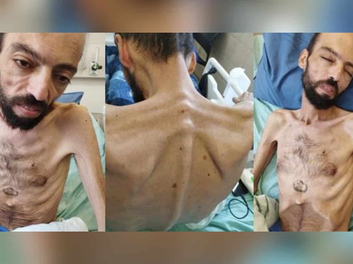Painful pictures of Palestinian hunger striker Khalil Awawda, turned into skeleton
