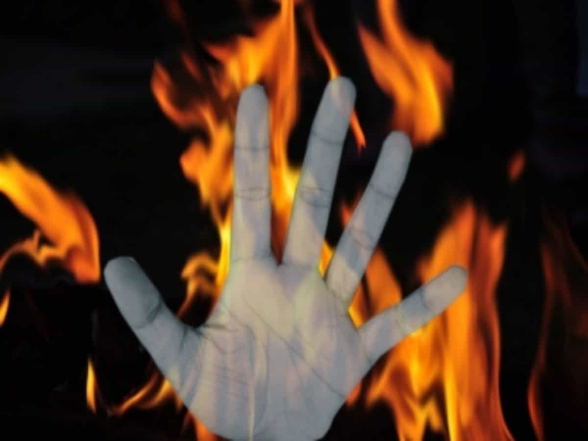 UP youth critical after being set afire by girlfriend's family