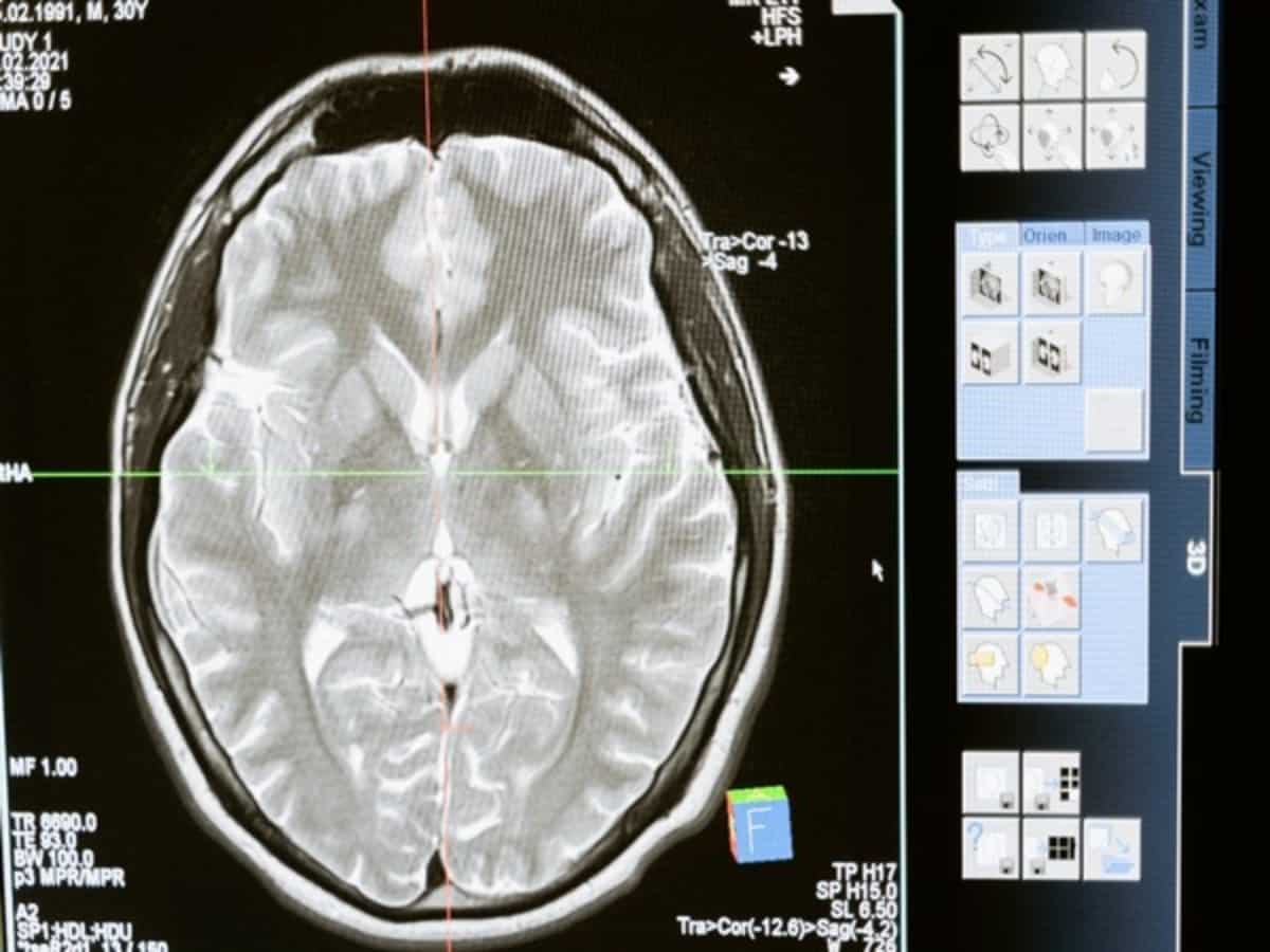 Study reveals process of how Parkinson's disease spreads in brain