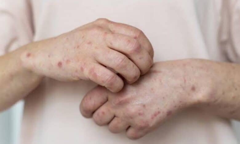 Fourth in Gulf, Bahrain reports first case of monkeypox
