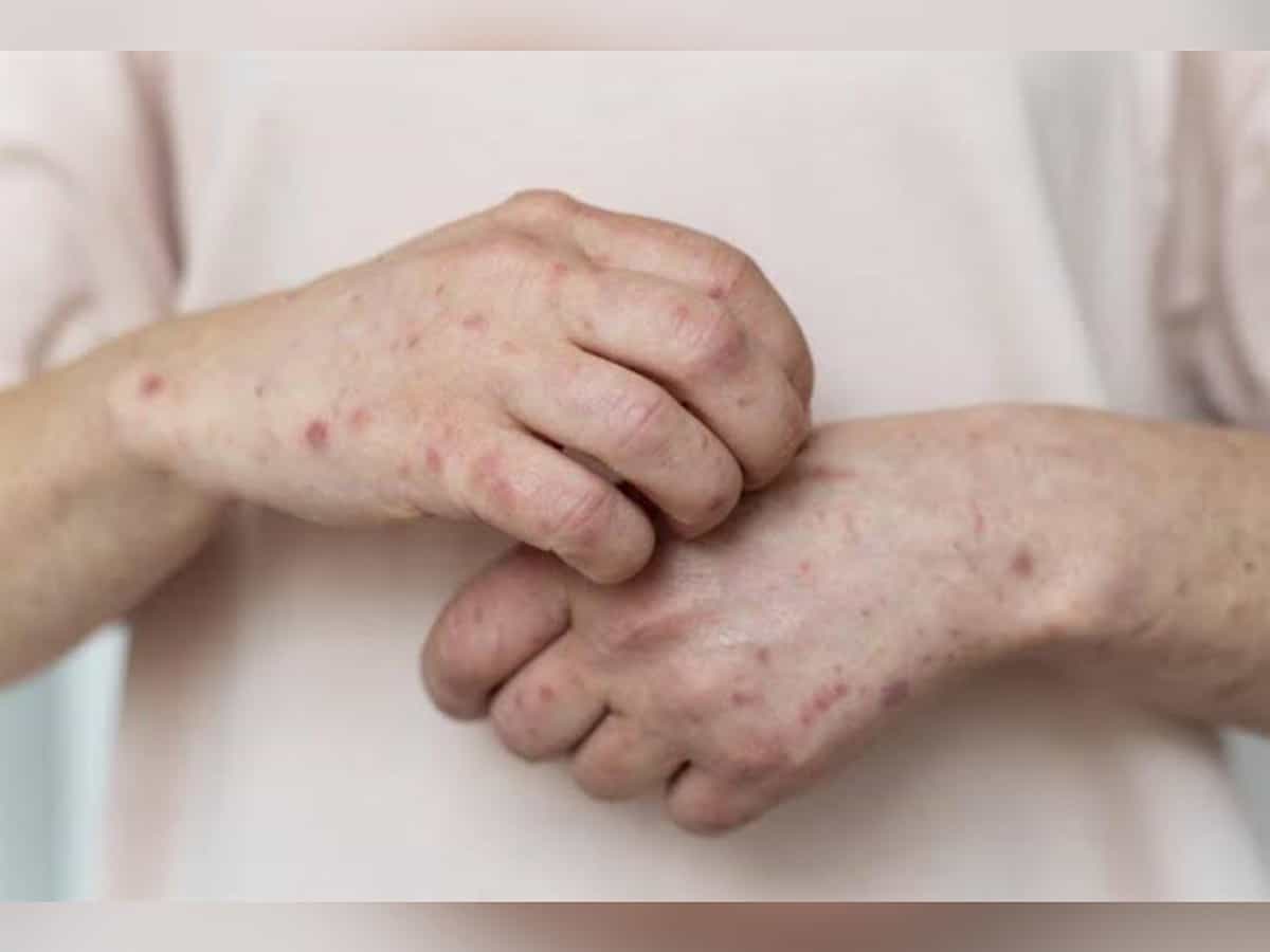 Fourth in Gulf, Bahrain reports first case of monkeypox