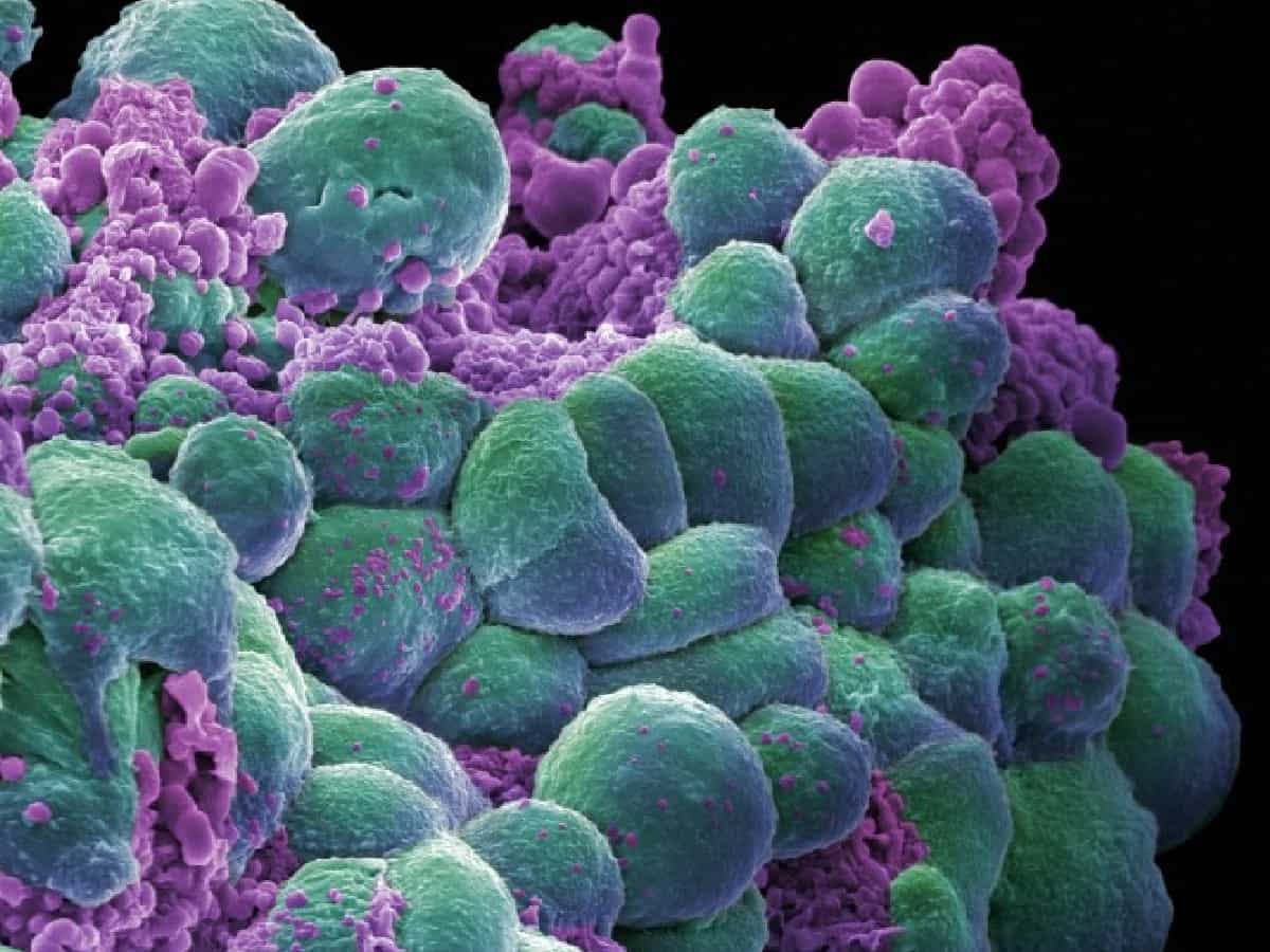 Cancers in adults under 50 on rise globally, study finds