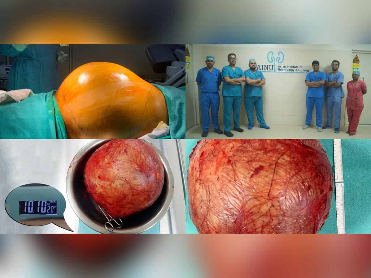 Doctors at Hyderabad hospital remove football-sized kidney tumour