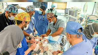 Saudi: Iraqi conjoined twins Ali, Omer successfully separated in 11-hour surgery