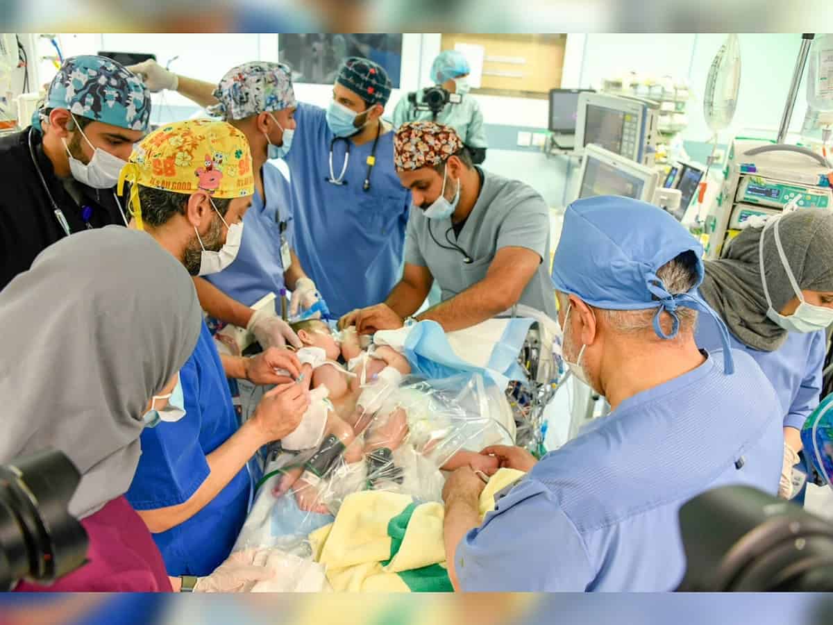 Saudi: Iraqi conjoined twins Ali, Omer successfully separated in 11-hour surgery