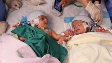 Saudi: Yemeni conjoined twins successfully separated in 8-hr surgery