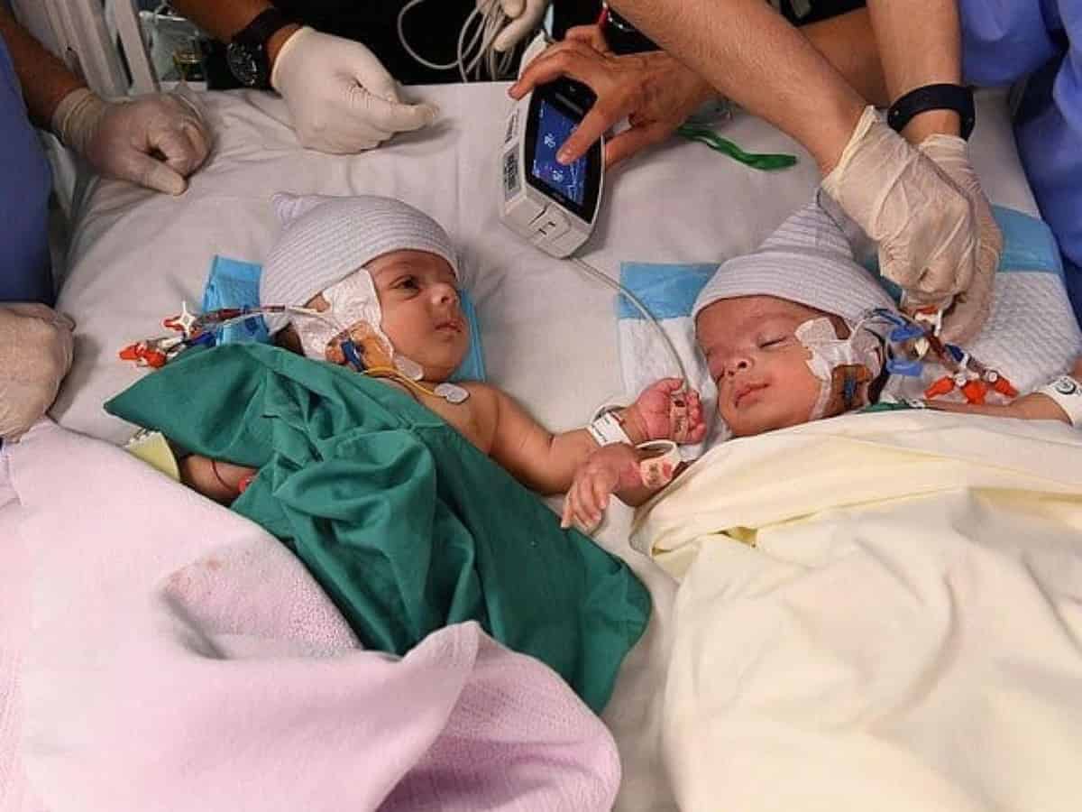 Saudi: Yemeni conjoined twins successfully separated in 8-hr surgery