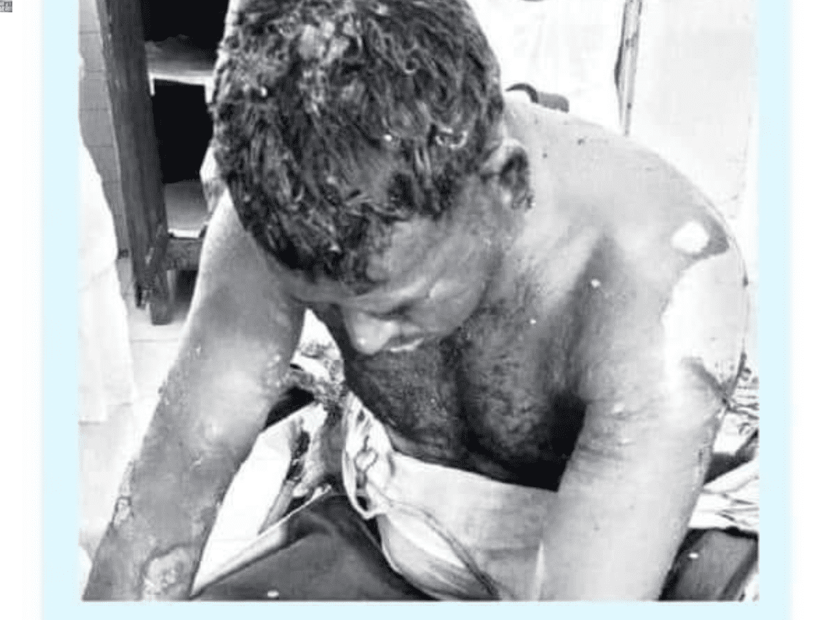 Telangana: Man set ablaze during Holi celebration in Medak