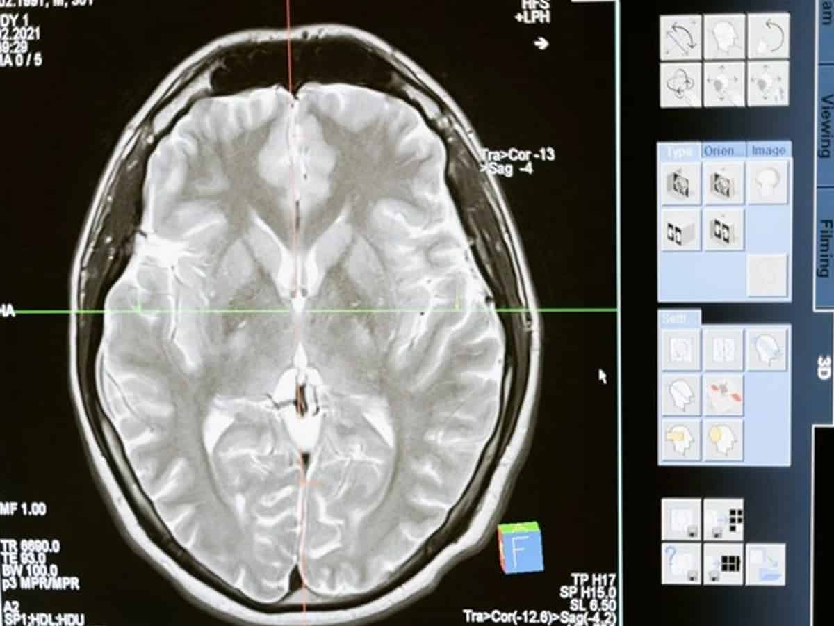 High BP in men in their 30s linked with dementia risk in their 70s