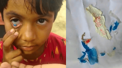 Plastic, paper coming out of girl's eye in Telangana's Mahbubabad